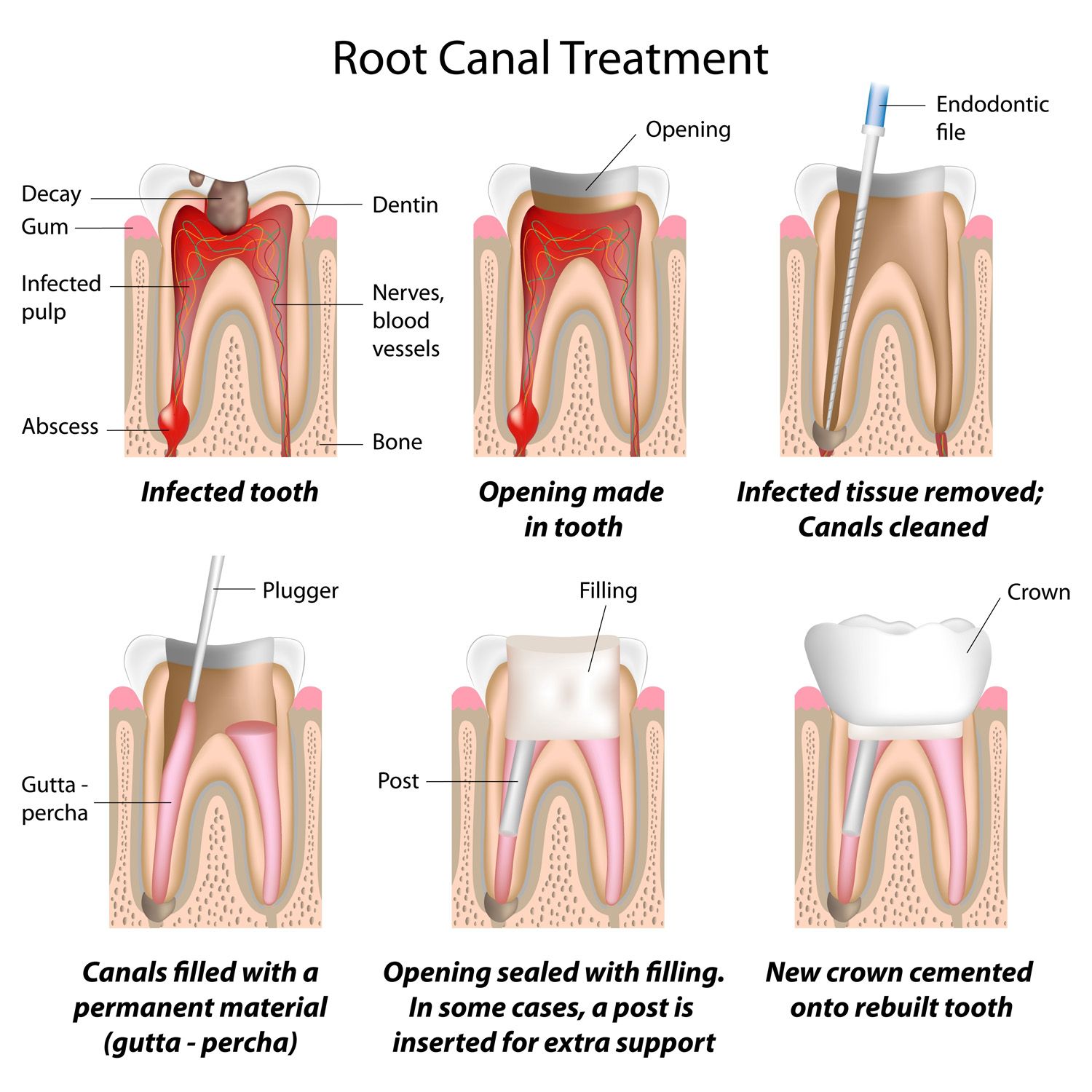 Root Canal Therapy - Illustration