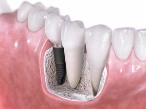 Dental crowns and implants Dr. Oldfin