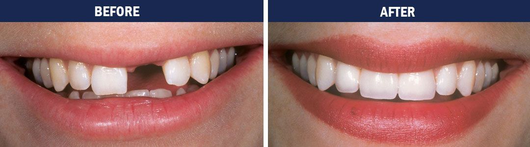 Dental Implants - before-and-after