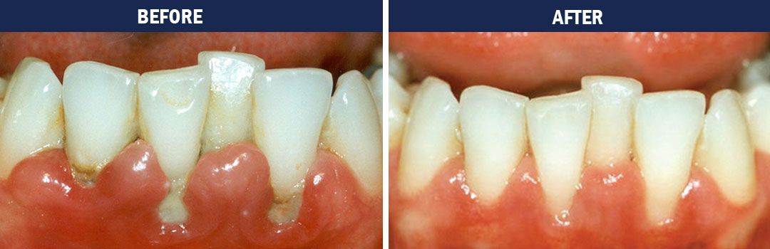 Gum Disease Therapy - Before and After Photo
