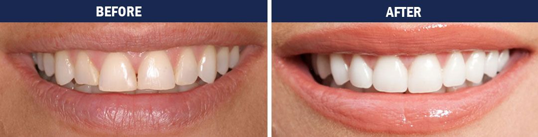 Porcelain Veneers - before and after photo