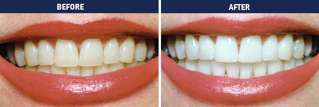 Teeth whitening - before-and-after