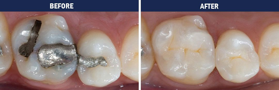trenton-dentist-white fillings-before-and-after